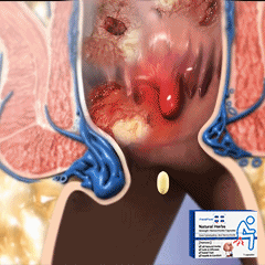 Capsules hémorroïdes à base des plantes naturelles et super efficace