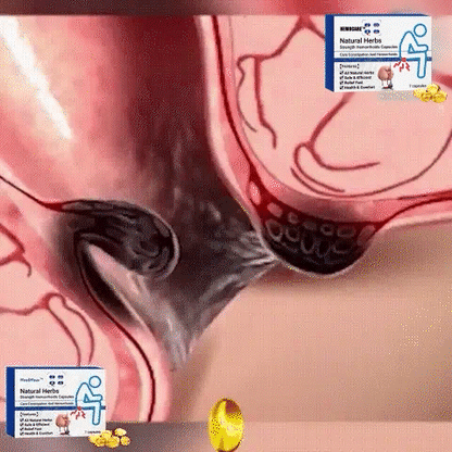 Capsules hémorroïdes à base des plantes naturelles et super efficace